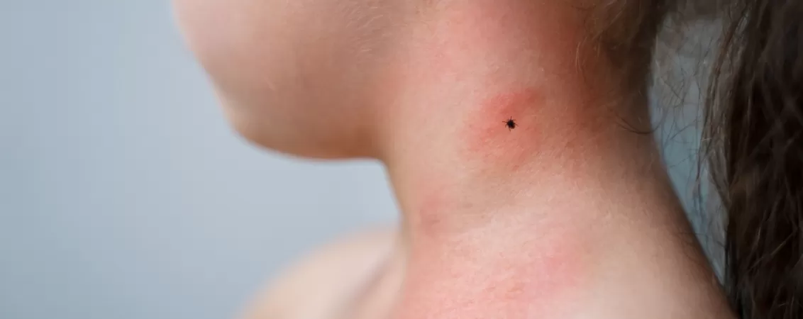 boala-lyme-la-copii-tot-ce-trebuie-sa-stii.jpg